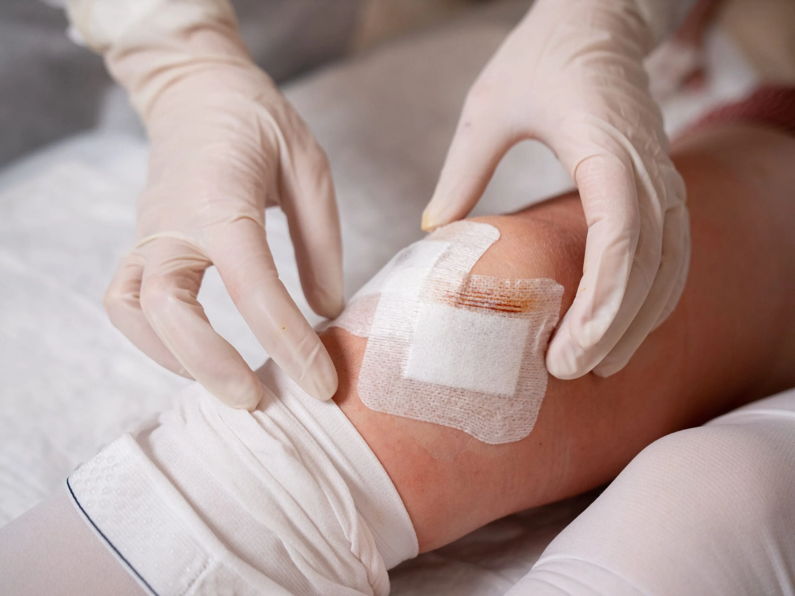 Profissional de saúde aplicando um curativo avançado na HiperClin